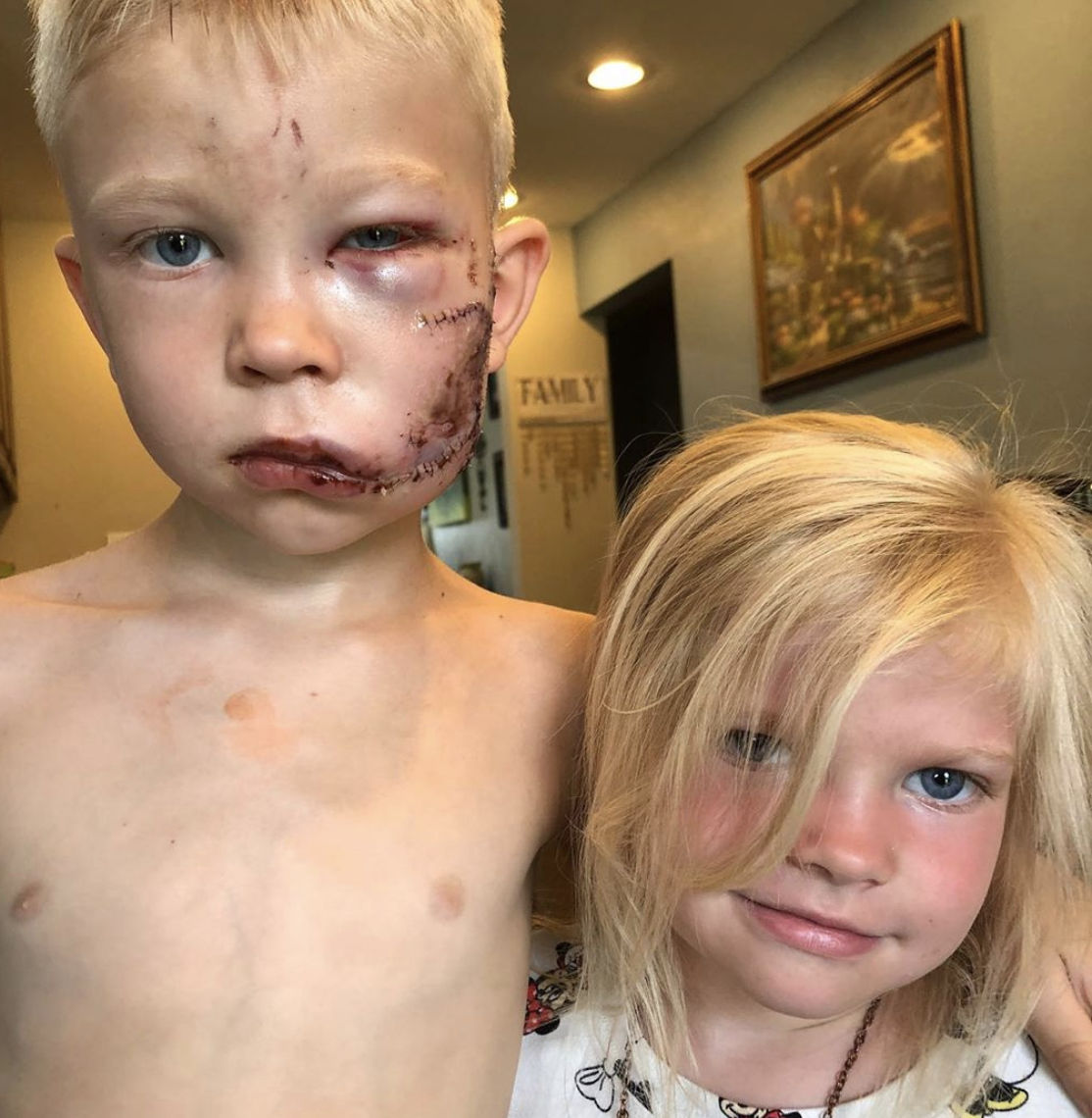 El pequeño posando con su hermana, con la cara toda cosida luego del ataque del perro.