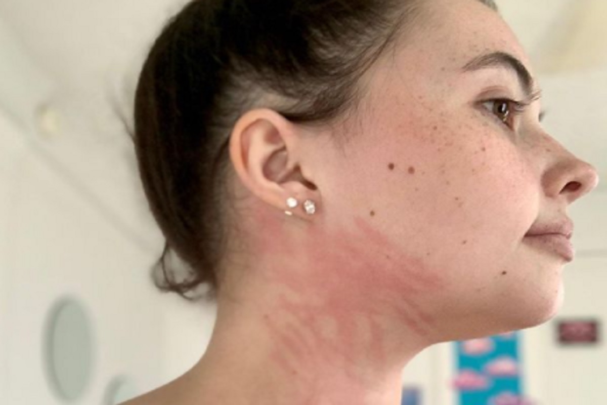 Tessa Hansen-Smith, de 22 años de California, es alérgica a sus propias lágrimas
