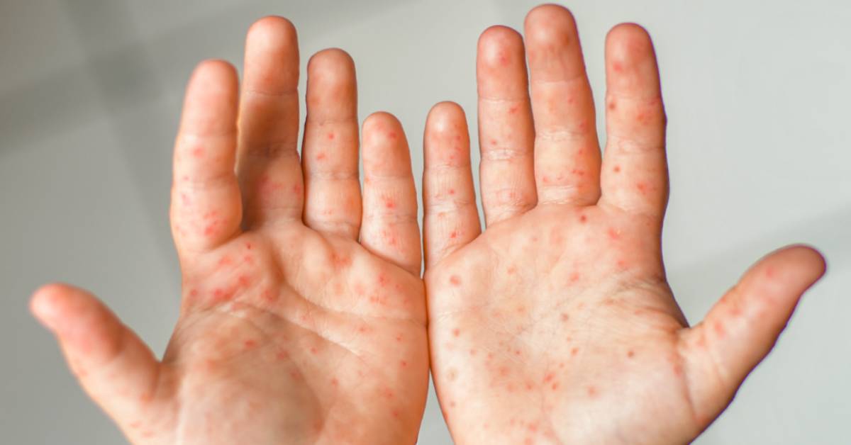 Advierten que virus de manos, pies y boca es más frecuente en menores de 5 años