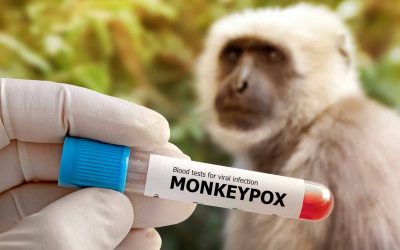 Viruela del mono: Confirman primer caso en Paraguay